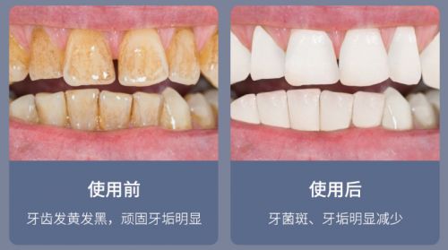 告別刷牙盲區，現代口腔護理新選擇 為何它能解決你的深層困擾